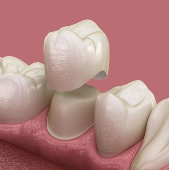 dental crowns treatment in thane – types, costs & benefits creative smiles