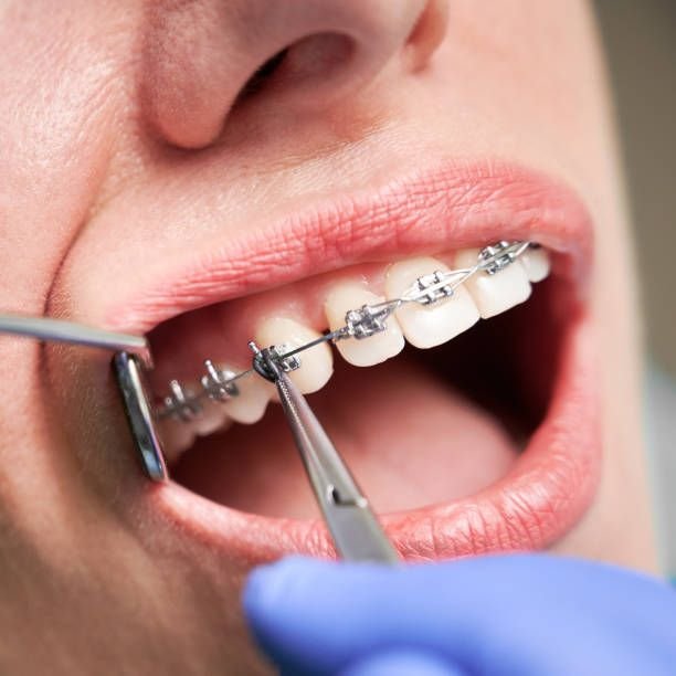 metal braces in superior co